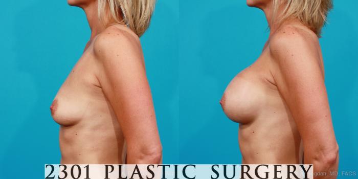 Before & After Silicone Implants Case 176 View #2 View in Fort Worth, Plano, & Frisco, Texas