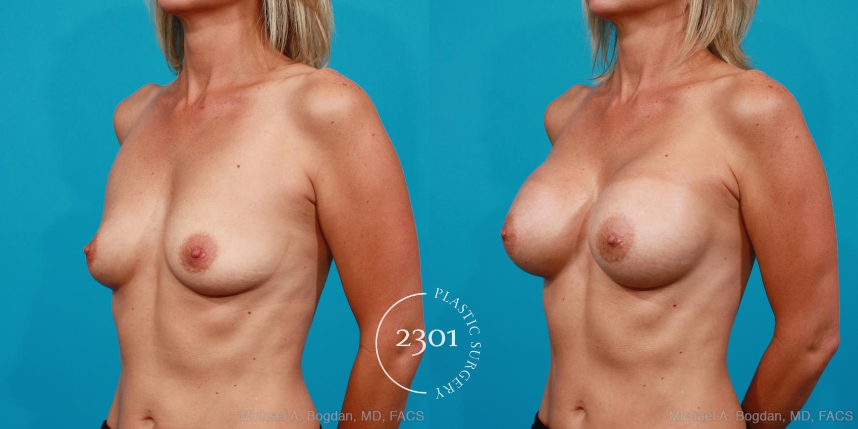 Before & After Silicone Implants Case 176 View #3 View in Fort Worth, Plano, & Frisco, Texas