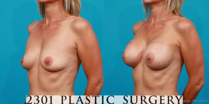 Before & After Silicone Implants Case 176 View #3 View in Fort Worth, Plano, & Frisco, Texas