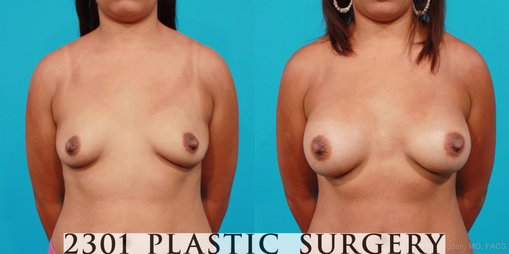 Before & After Silicone Implants Case 185 View #1 View in Fort Worth, Plano, & Frisco, Texas