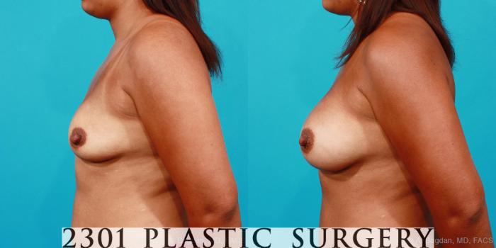 Before & After Silicone Implants Case 185 View #2 View in Fort Worth, Plano, & Frisco, Texas