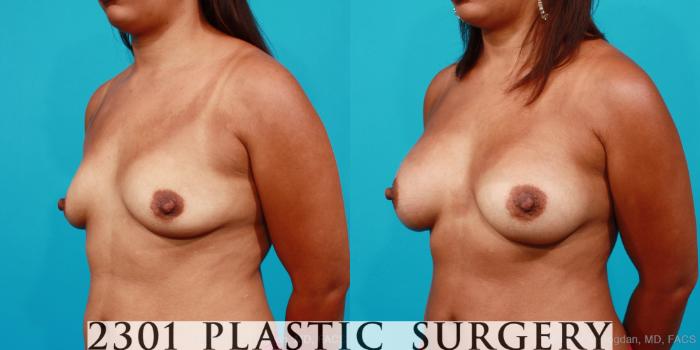 Before & After Silicone Implants Case 185 View #3 View in Fort Worth, Plano, & Frisco, Texas