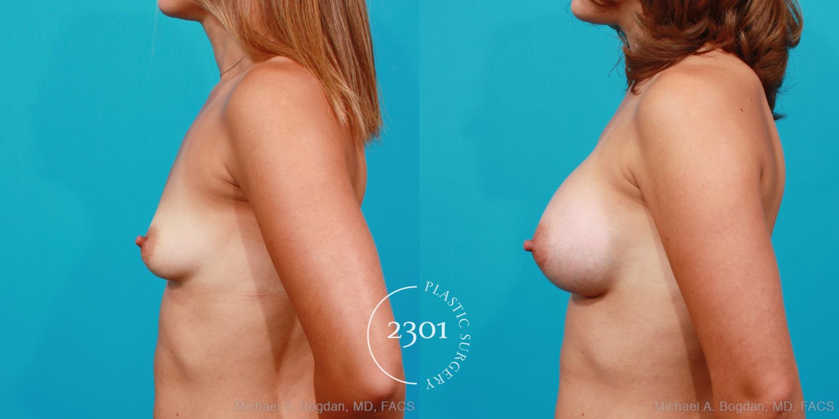 Before & After Silicone Implants Case 196 View #2 View in Fort Worth, Plano, & Frisco, Texas