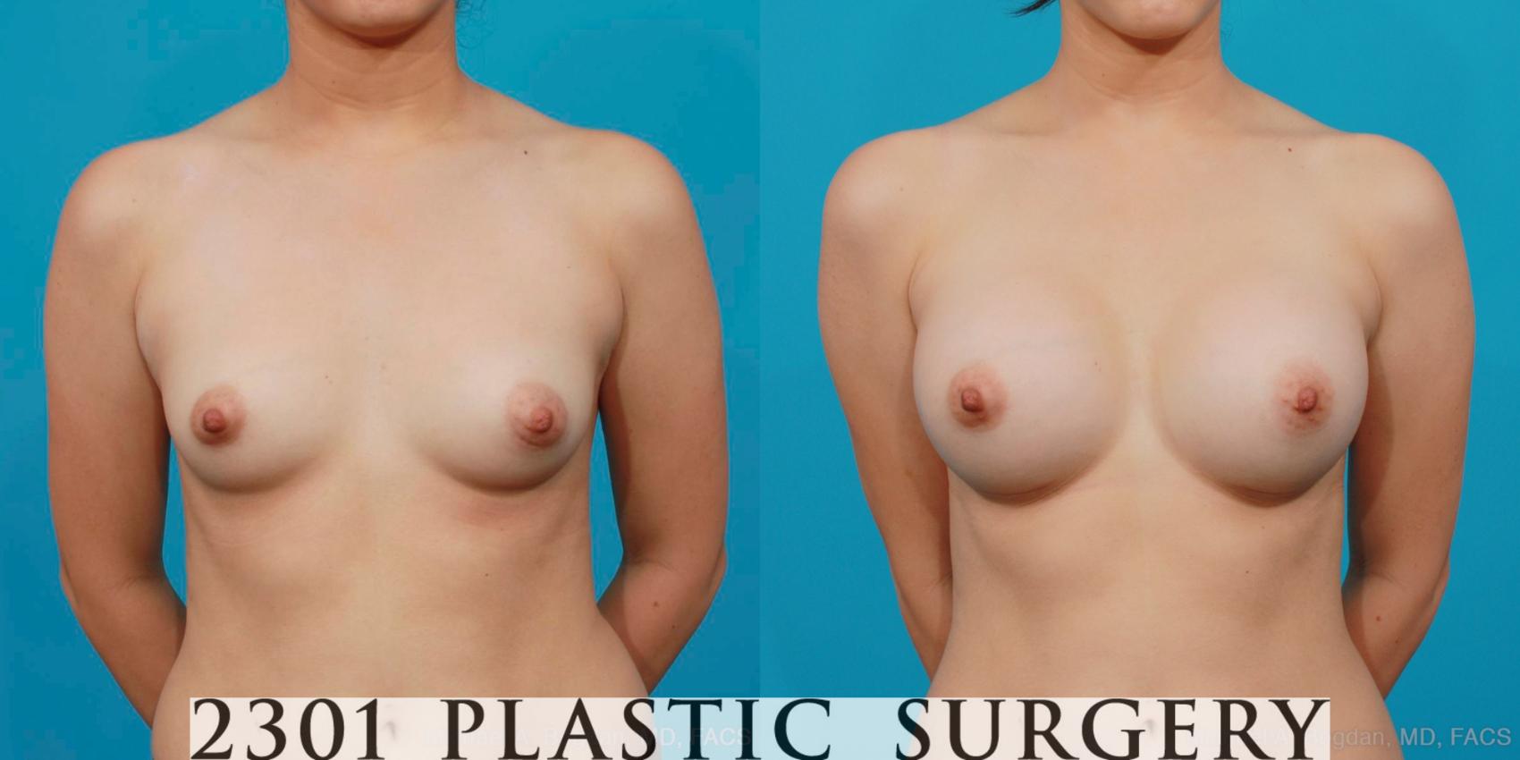 Before & After Silicone Implants Case 199 View #1 View in Fort Worth, Plano, & Frisco, Texas
