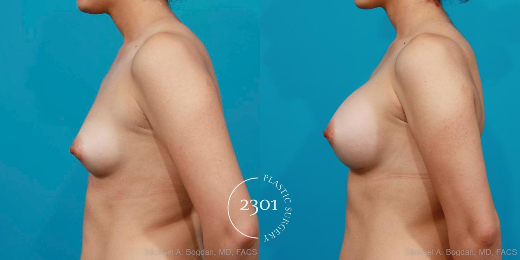 Before & After Silicone Implants Case 199 View #2 View in Fort Worth, Plano, & Frisco, Texas