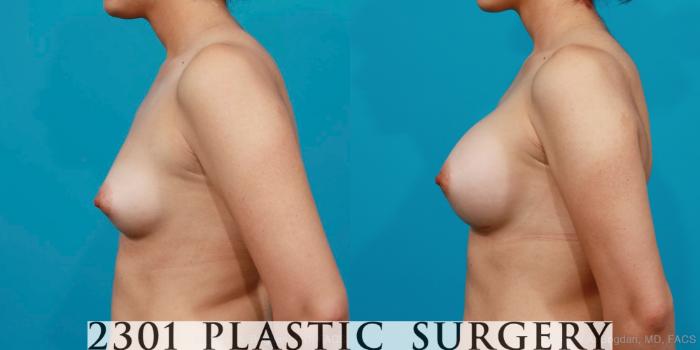 Before & After Silicone Implants Case 199 View #2 View in Fort Worth, Plano, & Frisco, Texas