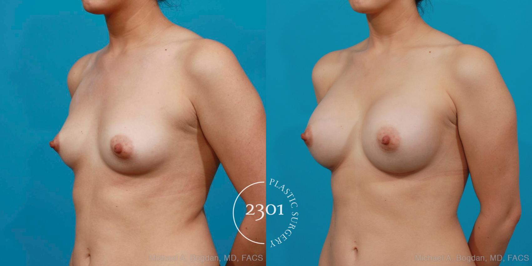 Before & After Silicone Implants Case 199 View #3 View in Fort Worth, Plano, & Frisco, Texas