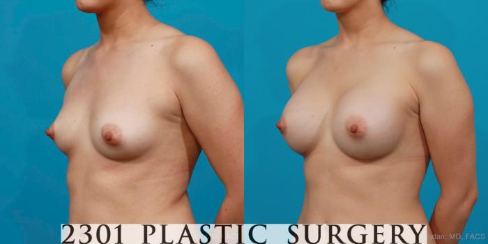 Before & After Silicone Implants Case 199 View #3 View in Fort Worth, Plano, & Frisco, Texas