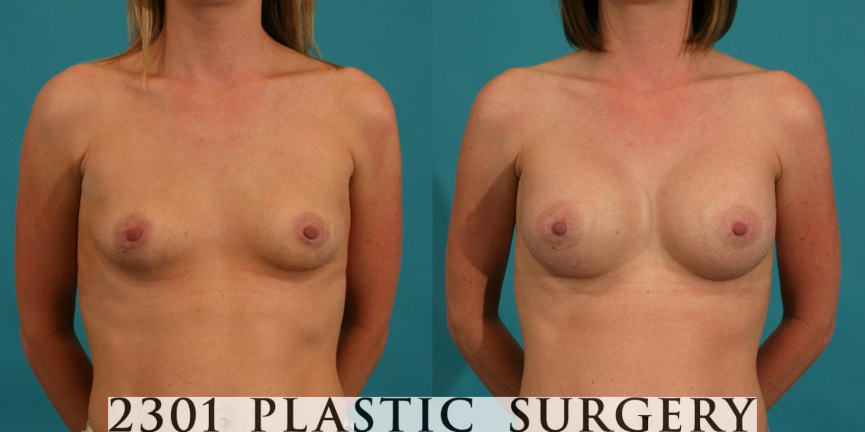 Before & After Silicone Implants Case 2 View #1 View in Fort Worth, Plano, & Frisco, Texas