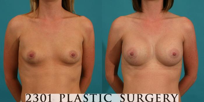 Before & After Silicone Implants Case 2 View #1 View in Fort Worth, Plano, & Frisco, Texas