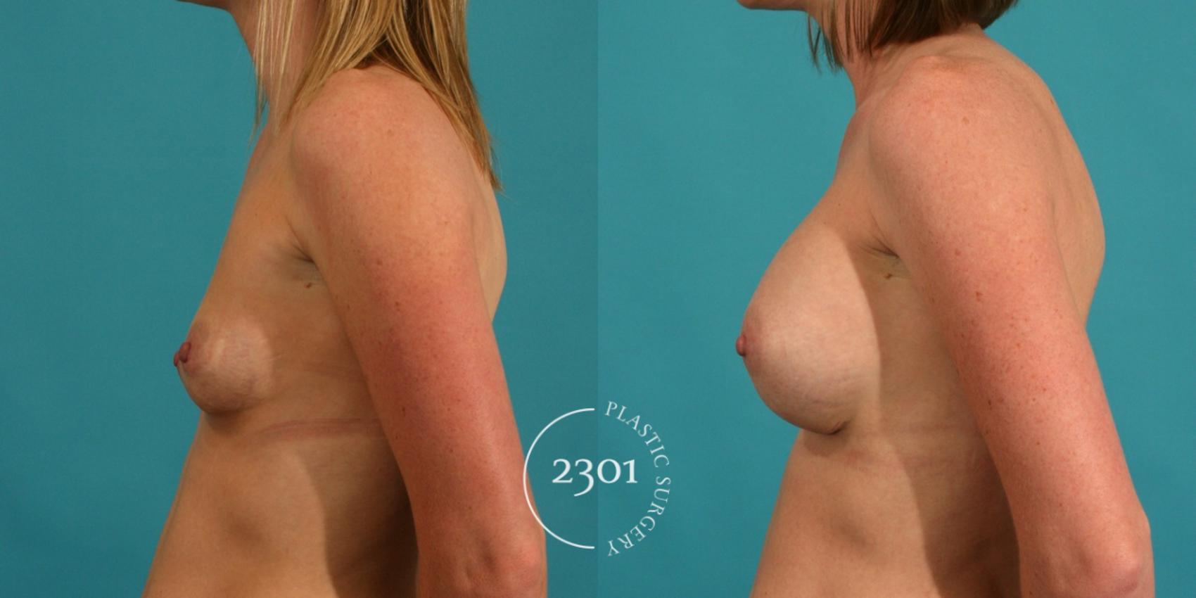 Before & After Silicone Implants Case 2 View #2 View in Fort Worth, Plano, & Frisco, Texas