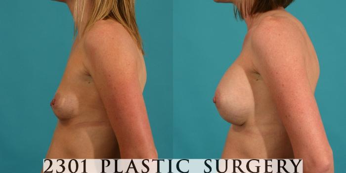 Before & After Breast Augmentation Case 2 View #2 View in Fort Worth, Plano, & Frisco, Texas