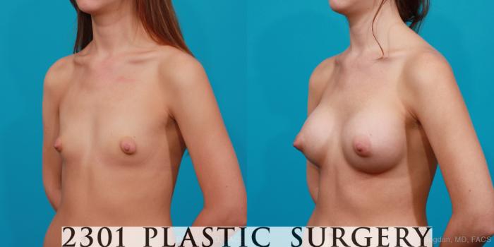 Before & After Silicone Implants Case 202 View #3 View in Fort Worth, Plano, & Frisco, Texas