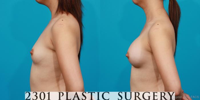 Before & After Silicone Implants Case 205 View #2 View in Fort Worth, Plano, & Frisco, Texas