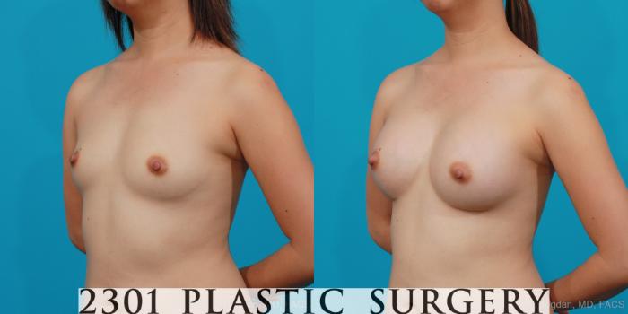 Before & After Silicone Implants Case 205 View #3 View in Fort Worth, Plano, & Frisco, Texas