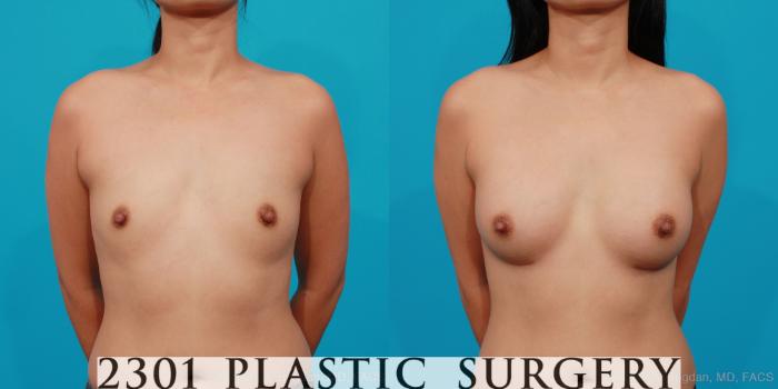 Before & After Silicone Implants Case 206 View #1 View in Fort Worth, Plano, & Frisco, Texas