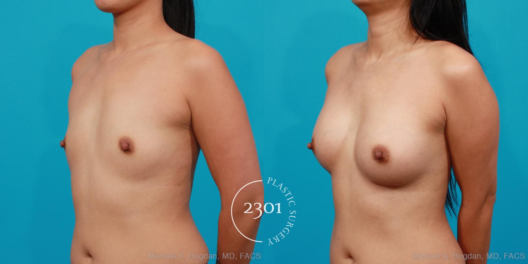 Before & After Silicone Implants Case 206 View #3 View in Fort Worth, Plano, & Frisco, Texas