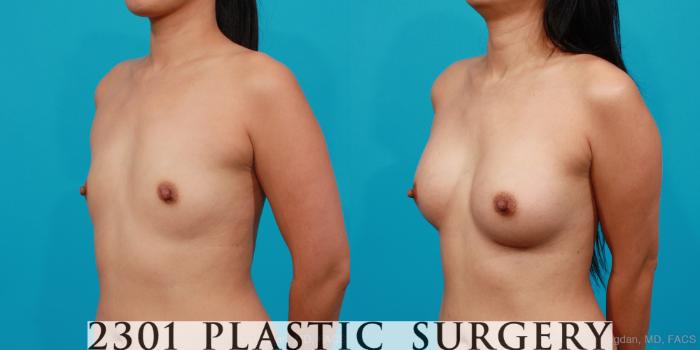Before & After Silicone Implants Case 206 View #3 View in Fort Worth, Plano, & Frisco, Texas