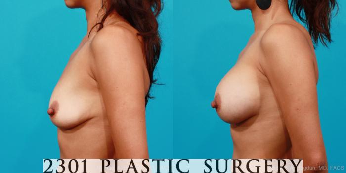 Before & After Silicone Implants Case 207 View #2 View in Fort Worth, Plano, & Frisco, Texas