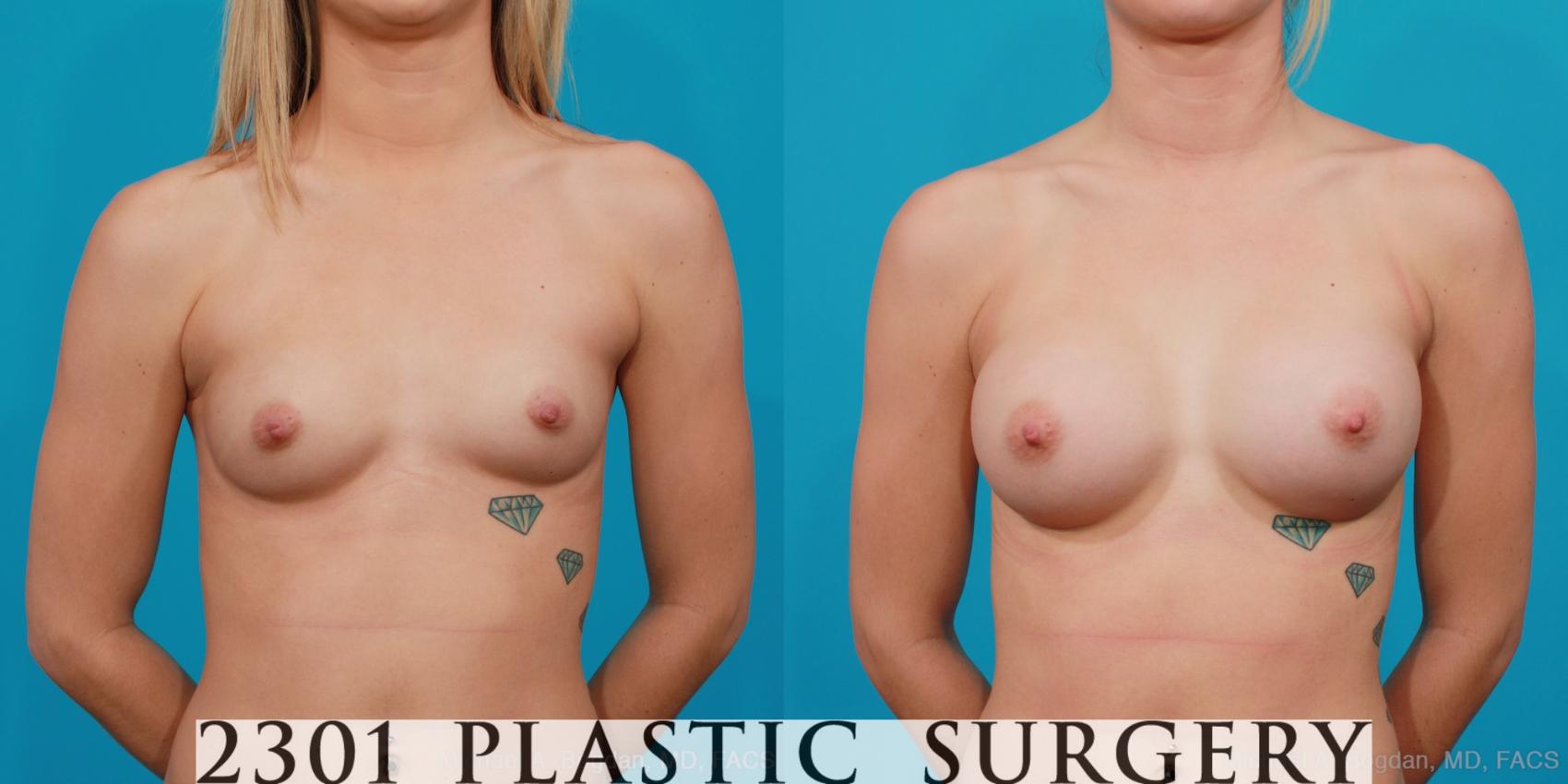 Before & After Silicone Implants Case 208 View #1 View in Fort Worth, Plano, & Frisco, Texas