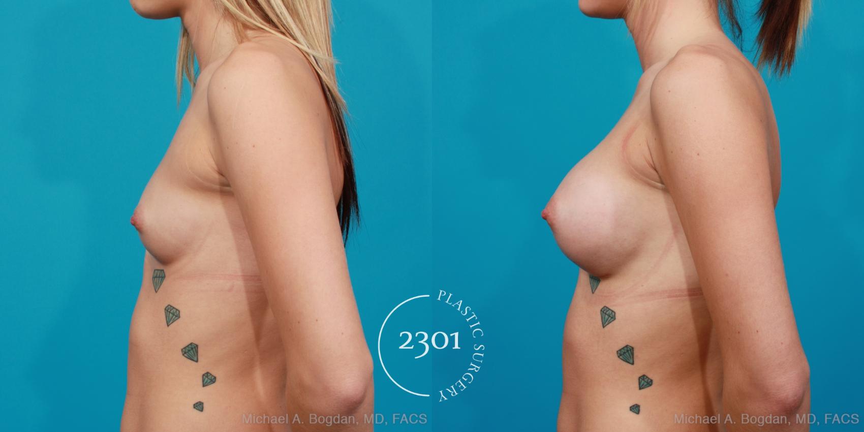 Before & After Silicone Implants Case 208 View #2 View in Fort Worth, Plano, & Frisco, Texas