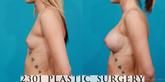 Before & After Silicone Implants Case 208 View #2 View in Fort Worth, Plano, & Frisco, Texas