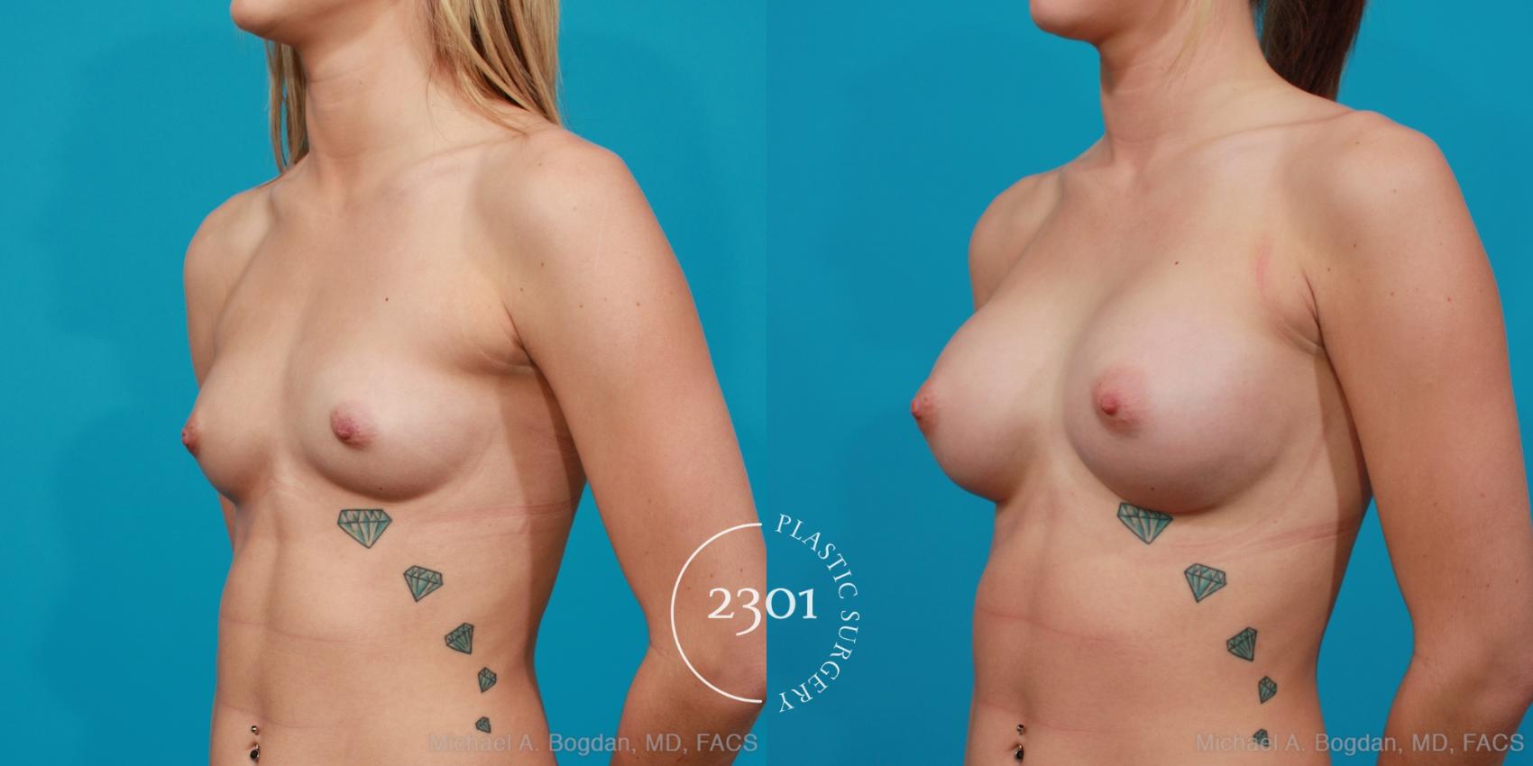 Before & After Silicone Implants Case 208 View #3 View in Fort Worth, Plano, & Frisco, Texas