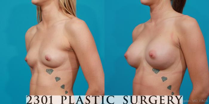 Before & After Silicone Implants Case 208 View #3 View in Fort Worth, Plano, & Frisco, Texas