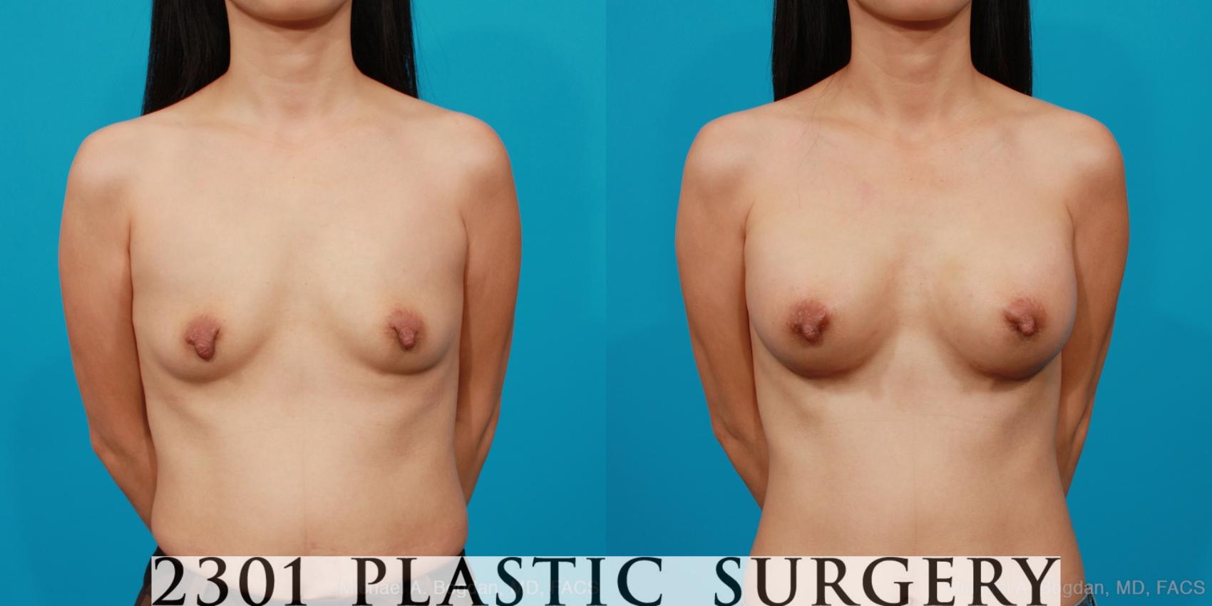 Before & After Silicone Implants Case 217 View #1 View in Fort Worth & Frisco, Texas