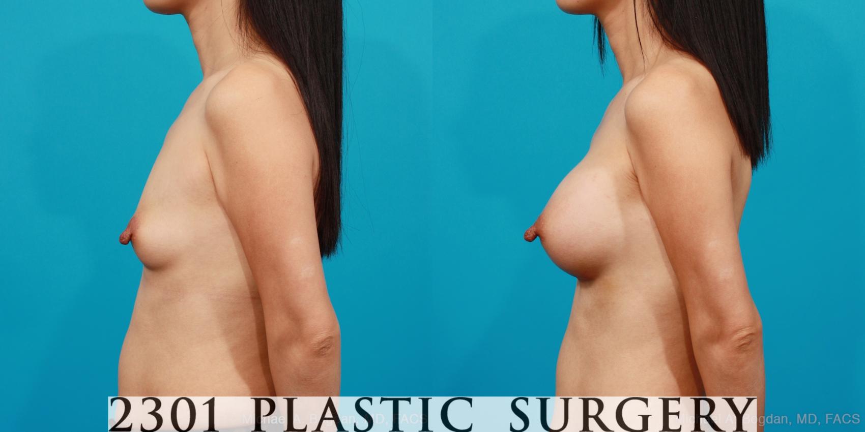 Before & After Silicone Implants Case 217 View #2 View in Fort Worth & Frisco, Texas