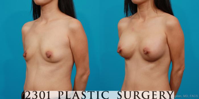 Before & After Breast Augmentation Case 217 View #3 View in Fort Worth, Plano, & Frisco, Texas