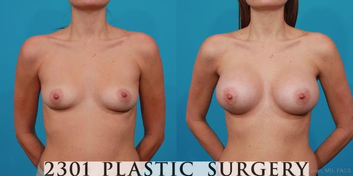 Before & After Silicone Implants Case 224 View #1 View in Fort Worth, Plano, & Frisco, Texas