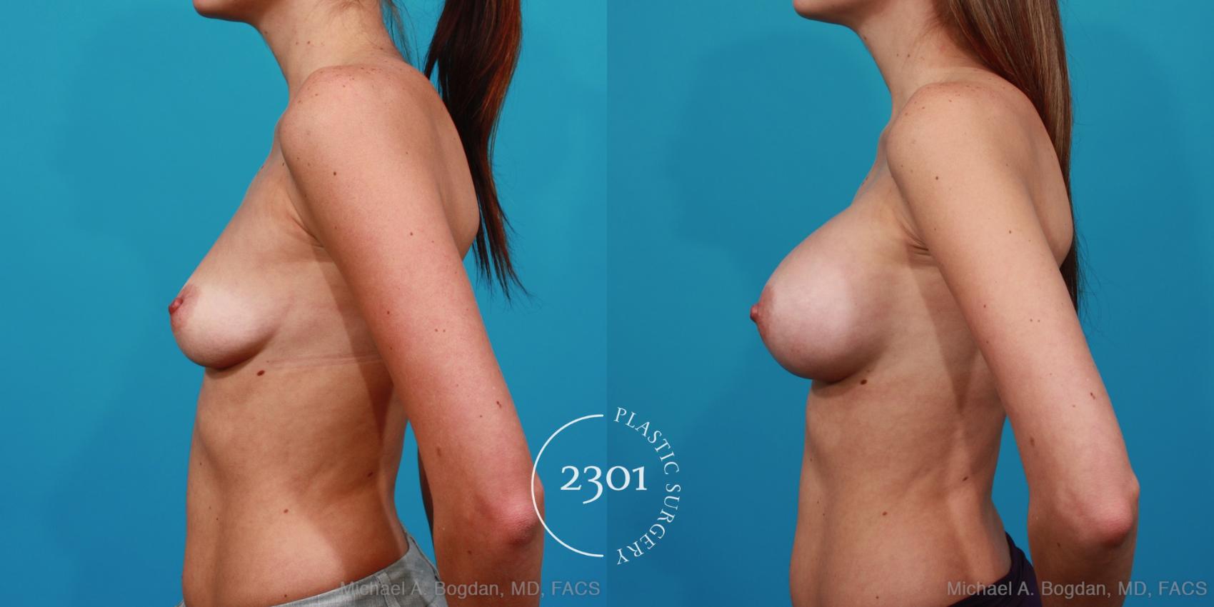 Before & After Silicone Implants Case 224 View #2 View in Fort Worth, Plano, & Frisco, Texas
