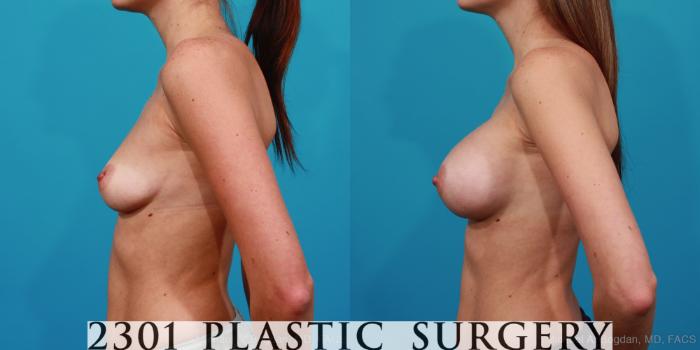 Before & After Silicone Implants Case 224 View #2 View in Fort Worth, Plano, & Frisco, Texas