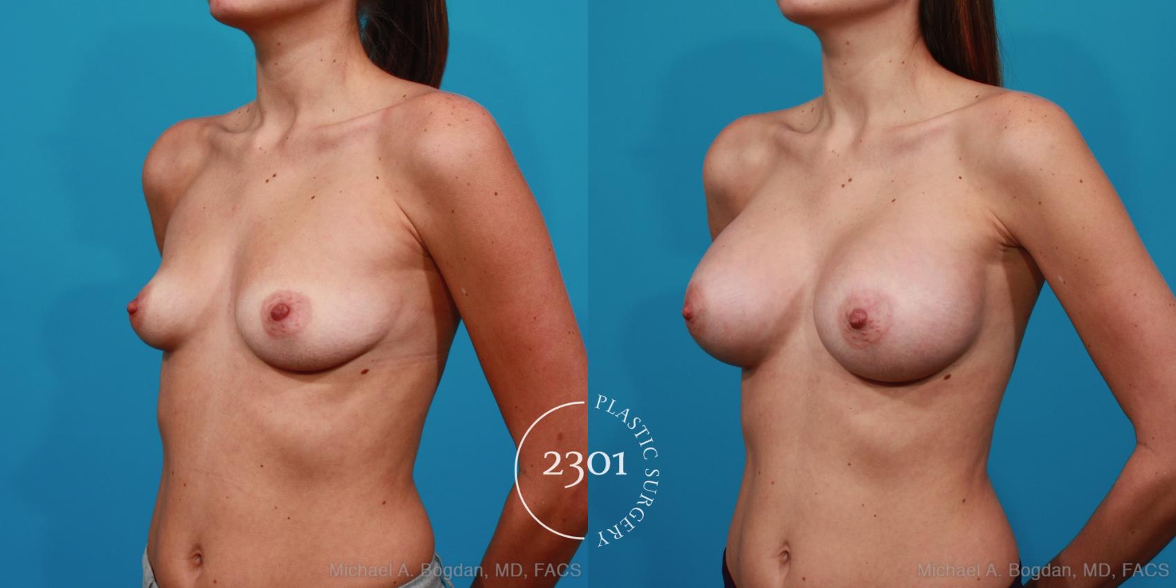Before & After Silicone Implants Case 224 View #3 View in Fort Worth, Plano, & Frisco, Texas