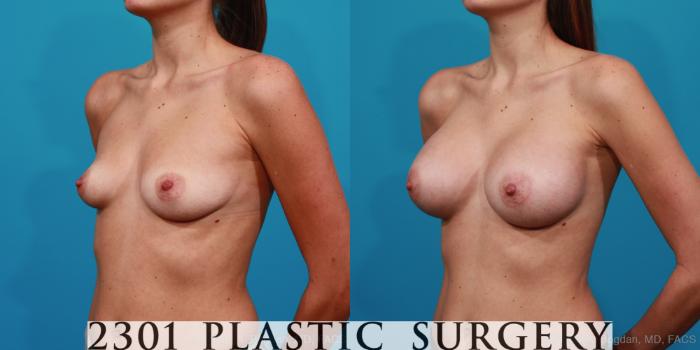 Before & After Silicone Implants Case 224 View #3 View in Fort Worth, Plano, & Frisco, Texas