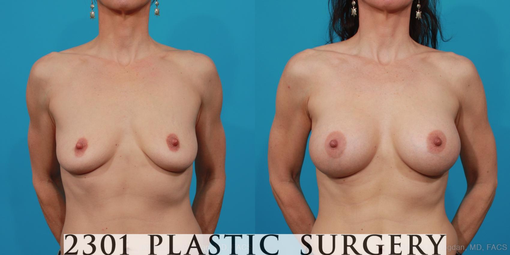 Before & After Silicone Implants Case 225 View #1 View in Fort Worth, Plano, & Frisco, Texas