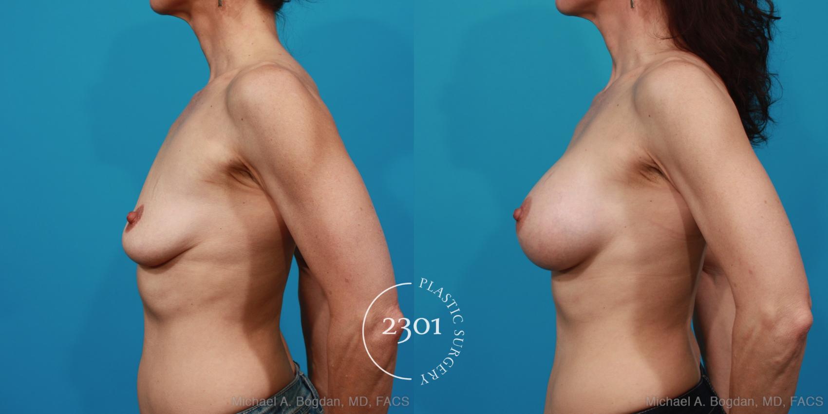 Before & After Silicone Implants Case 225 View #2 View in Fort Worth, Plano, & Frisco, Texas