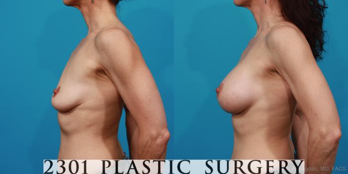 Before & After Silicone Implants Case 225 View #2 View in Fort Worth, Plano, & Frisco, Texas