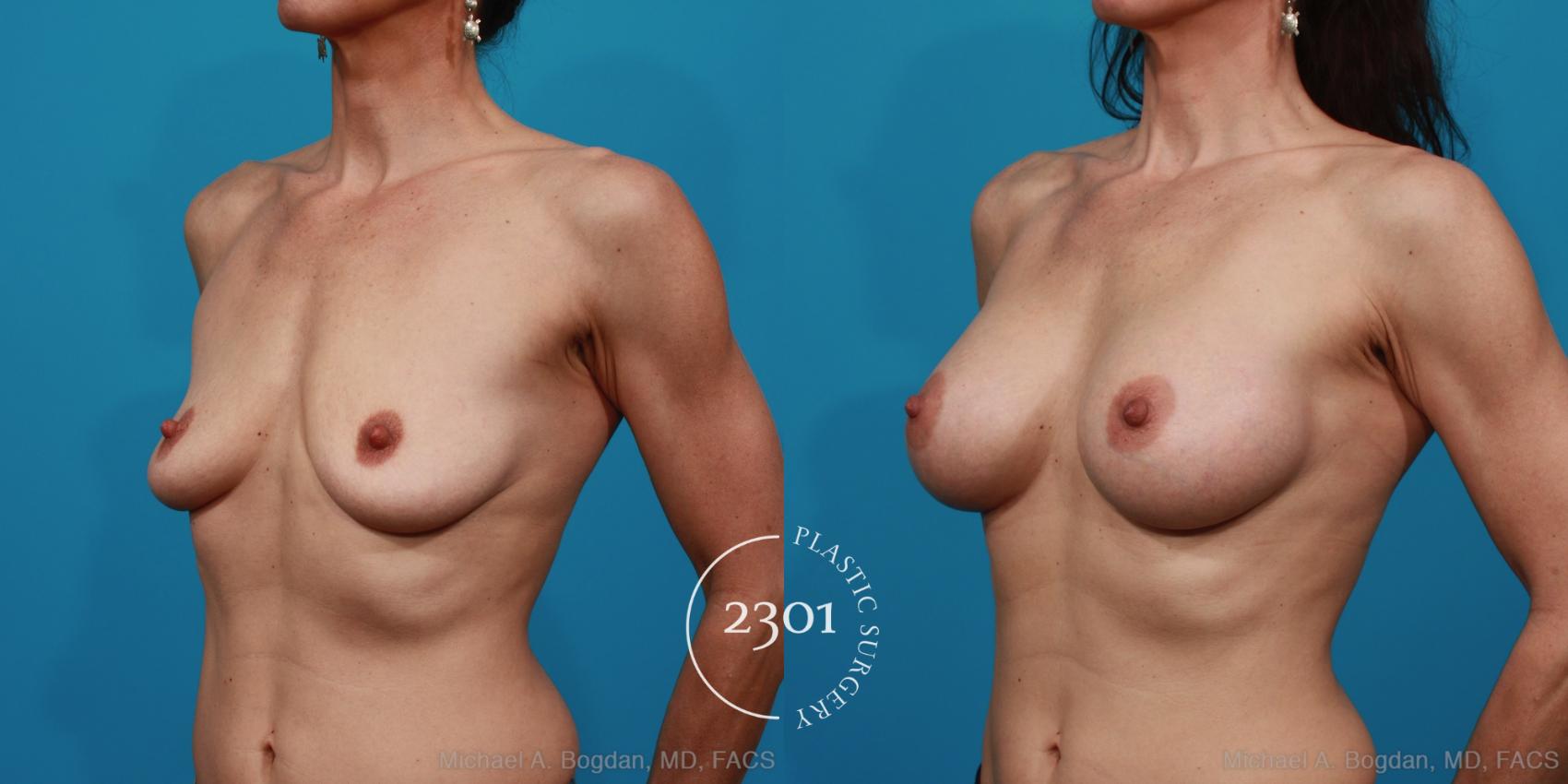 Before & After Silicone Implants Case 225 View #3 View in Fort Worth, Plano, & Frisco, Texas