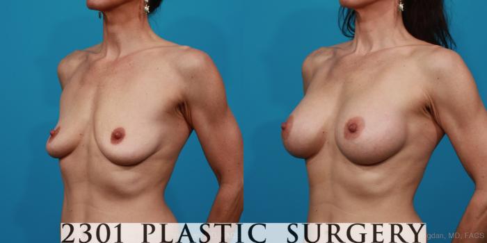 Before & After Silicone Implants Case 225 View #3 View in Fort Worth, Plano, & Frisco, Texas