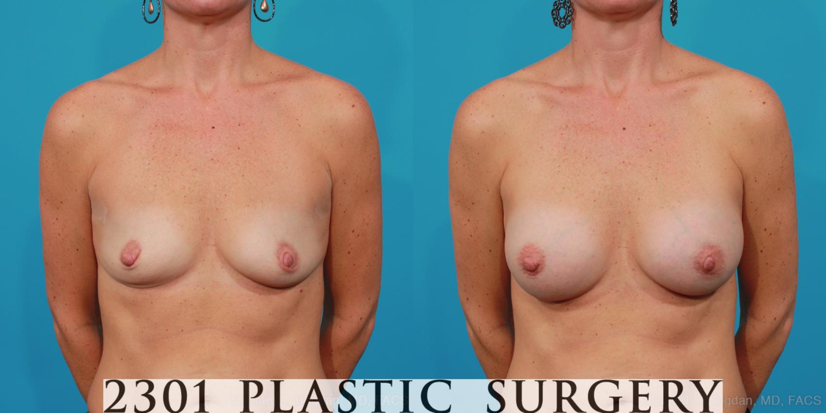 Before & After Silicone Implants Case 226 View #1 View in Fort Worth, Plano, & Frisco, Texas