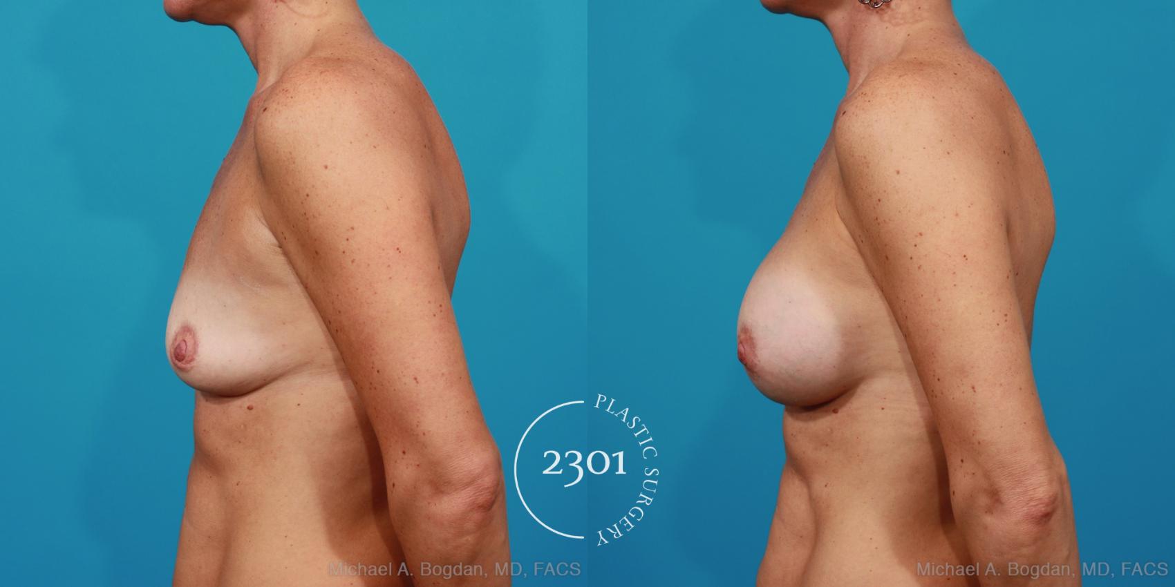 Before & After Silicone Implants Case 226 View #2 View in Fort Worth, Plano, & Frisco, Texas