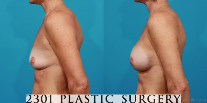 Before & After Silicone Implants Case 226 View #2 View in Fort Worth, Plano, & Frisco, Texas