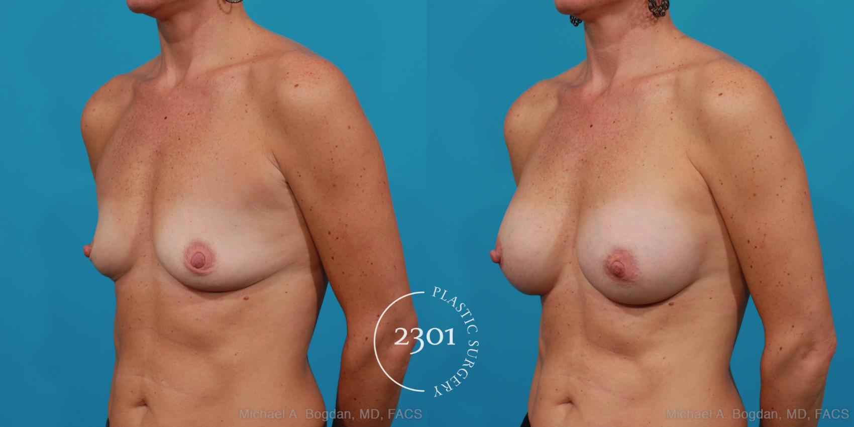 Before & After Silicone Implants Case 226 View #3 View in Fort Worth, Plano, & Frisco, Texas
