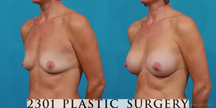 Before & After Silicone Implants Case 226 View #3 View in Fort Worth, Plano, & Frisco, Texas