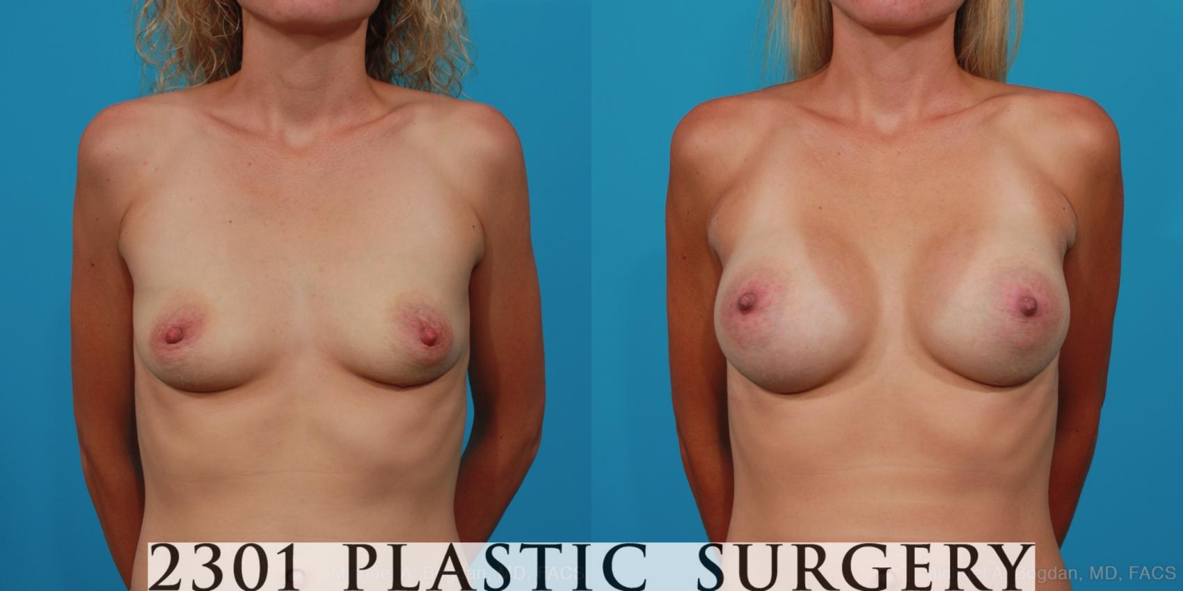 Before & After Silicone Implants Case 238 View #1 View in Fort Worth, Plano, & Frisco, Texas