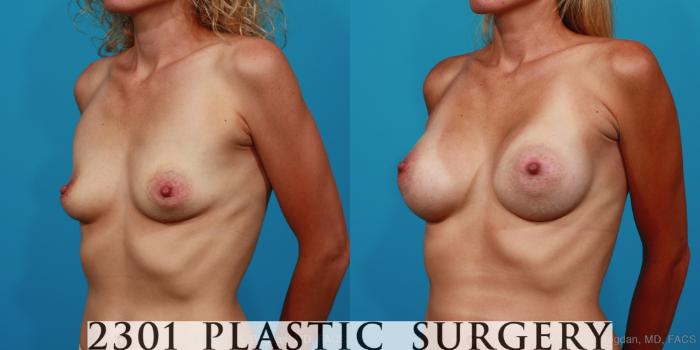 Before & After Silicone Implants Case 238 View #3 View in Fort Worth, Plano, & Frisco, Texas