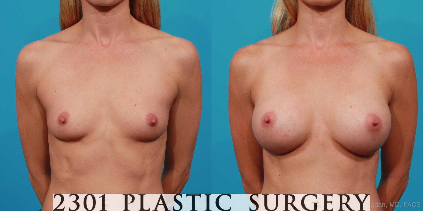 Before & After Breast Augmentation Case 239 View #1 View in Fort Worth, Plano, & Frisco, Texas