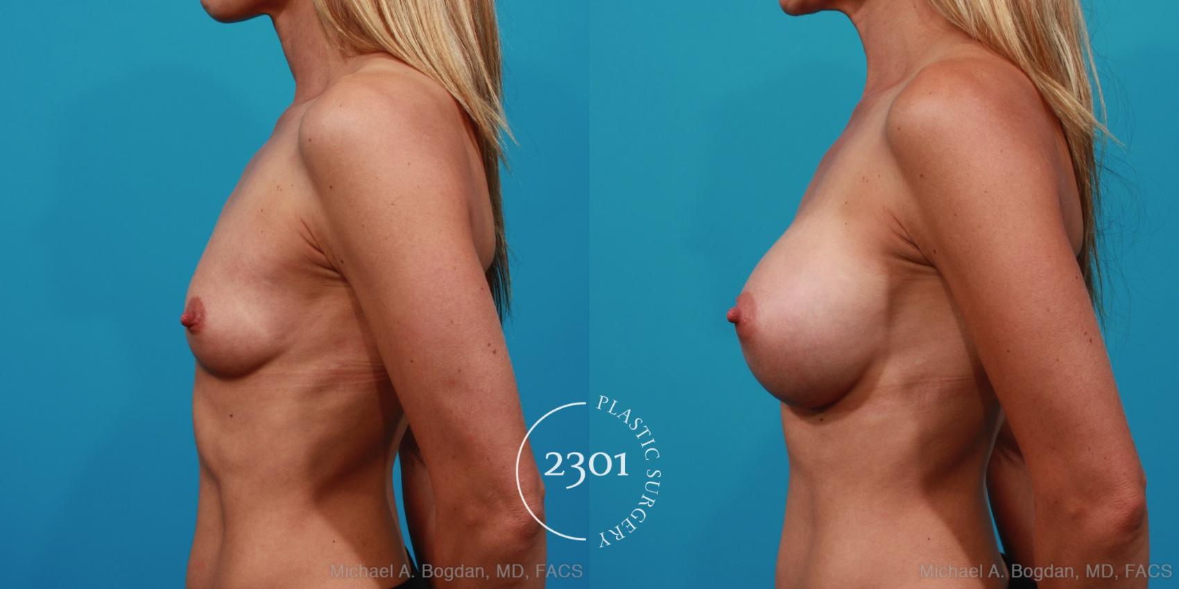 Before & After Breast Augmentation Case 239 View #2 View in Fort Worth, Plano, & Frisco, Texas